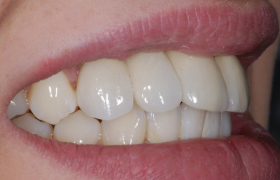 Esthétique sur implants