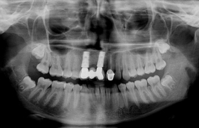 Esthétique sur implants