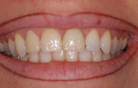 Esthétique sur implants