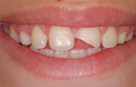 Cas 2 - stratification composite antérieur