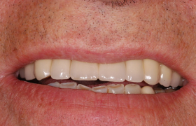 Couronnes sur implants