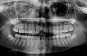 Esthétique sur implants