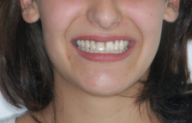 Esthétique sur implants