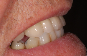 Couronnes sur implants