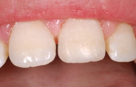 Cas 2 - stratification composite antérieur