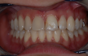 Esthétique sur implants