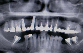 Couronnes sur implants
