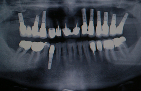 Couronnes sur implants